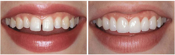 зубы после лечения у ортодонта