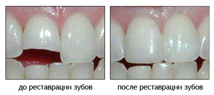 до и после реставрации зубов