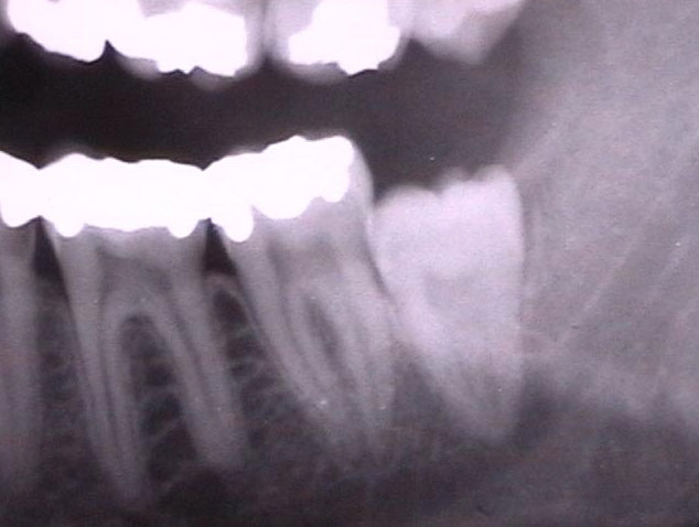 рентгеновский снимок ретинированного зуба мудрости