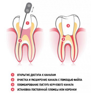 Болит запломбированный зуб при надавливании