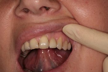 Что делать если болит зуб под пломбой