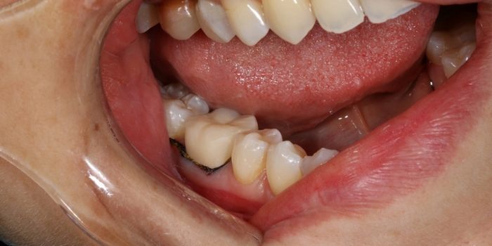 Так почему под пломбой болит зуб?