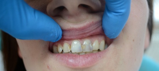 Кариес на передних зубах