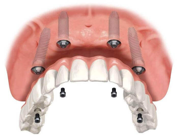 полное протезирование зубов