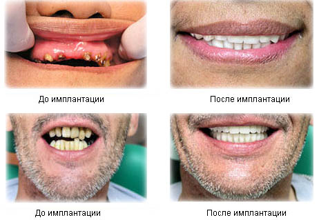 Рекомендации ухода после имплантации зубов