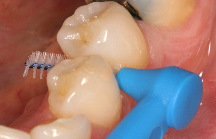 Рекомендации ухода после имплантации зубов