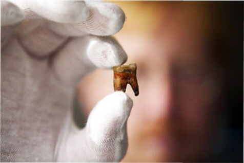 Удаление зуба в южном Бутово