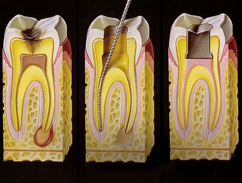 удаление зубного нерва мышьяком