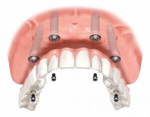 Зубной протез на имплантах