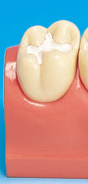 лечение кариеса зуба