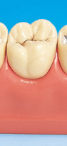 лечение кариеса зуба
